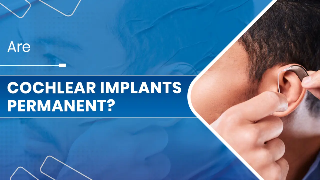 Cochlear Implants Permanent