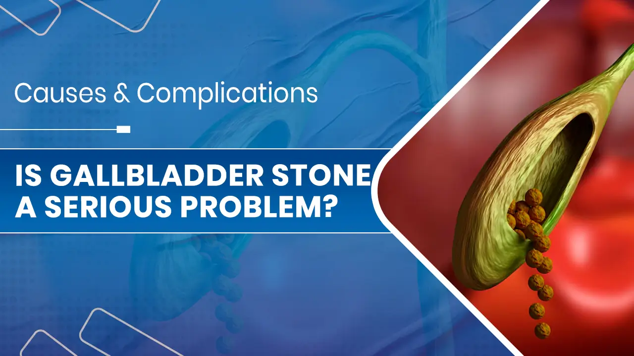 Gallbladder Stone a Serious Problem