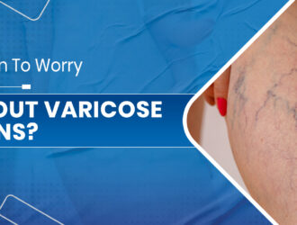 varicose veins