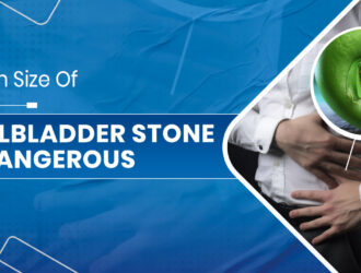 Gallbladder stone removal surgery