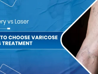 How to Choose Varicose Veins Treatment