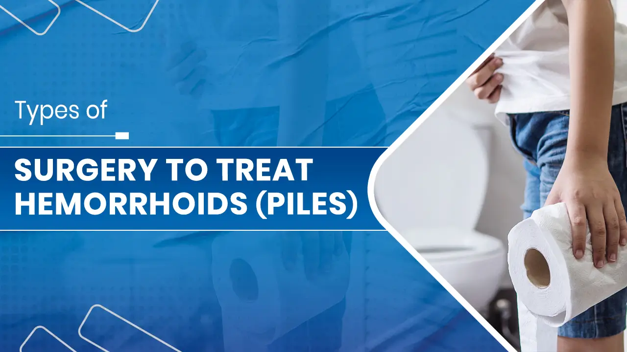 Surgery to Treat Hemorrhoids (Piles)