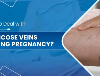 Varicose Veins during Pregnancy