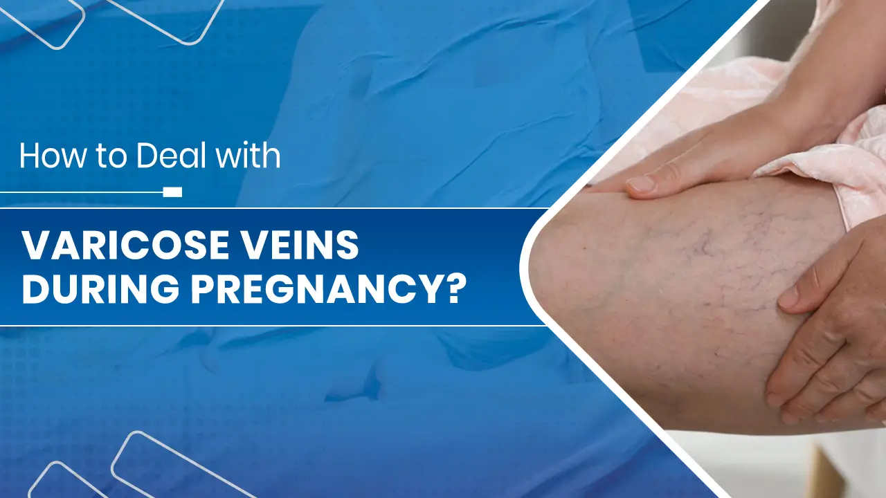 Varicose Veins during Pregnancy