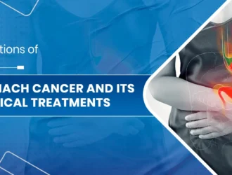 Stomach Cancer and Its Surgical Treatments