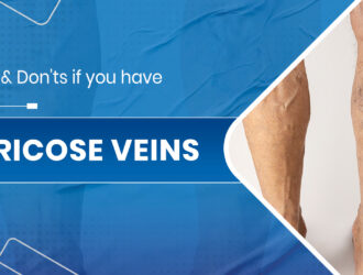 Varicose veins