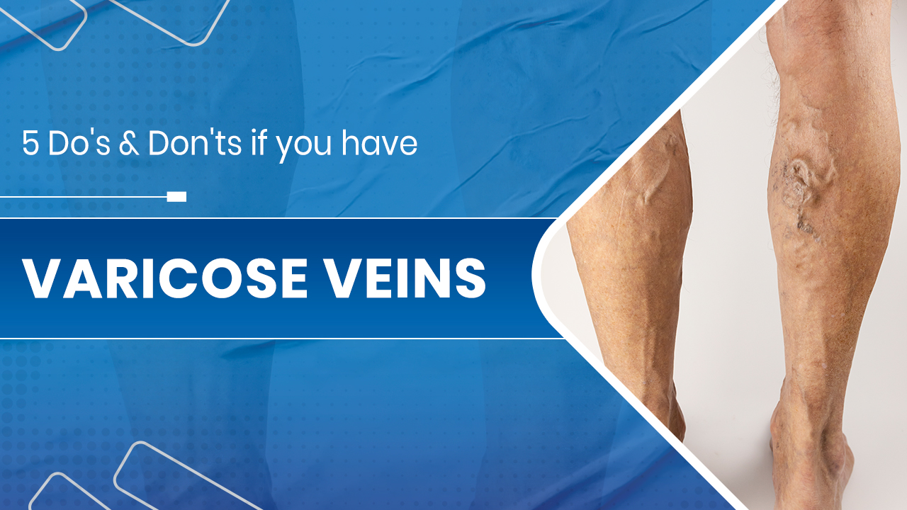 Varicose veins