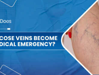 Varicose veins specialist