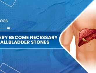 Gallbladder stones 01