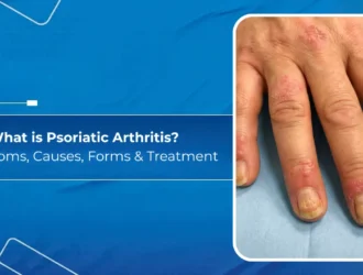 Psoriatic Arthritis -Symptoms, Causes, Forms & Treatment
