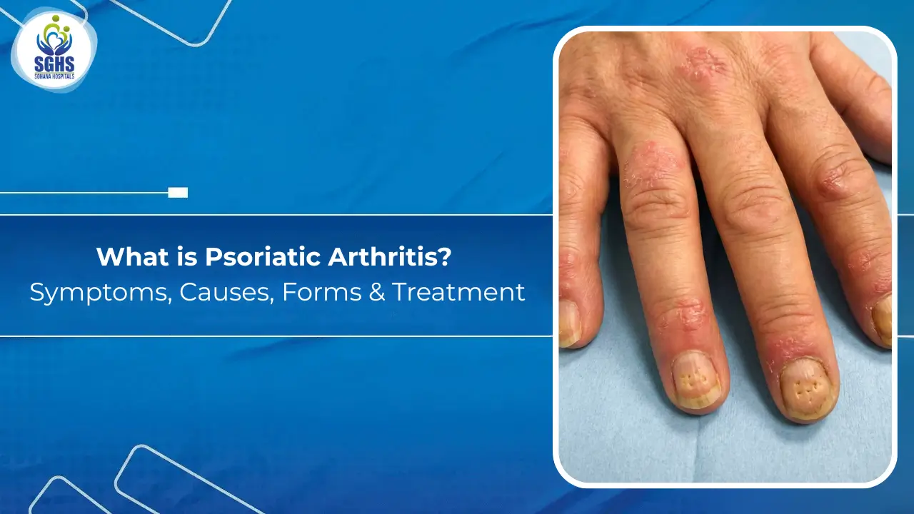 Psoriatic Arthritis -Symptoms, Causes, Forms & Treatment