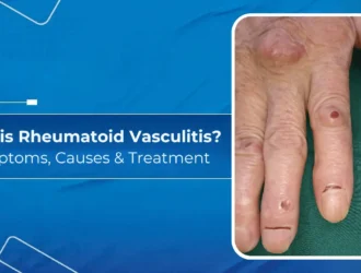 What is Rheumatoid -Vasculitis Symptoms, Causes & Treatment