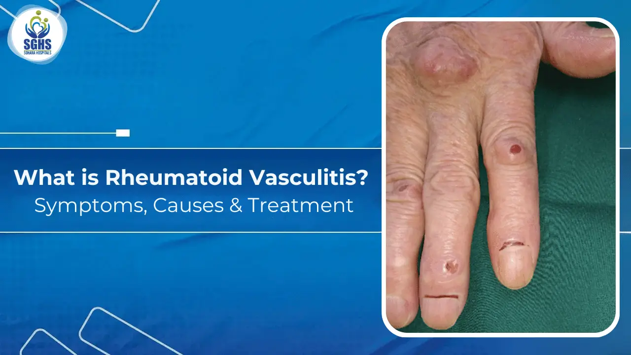 What is Rheumatoid -Vasculitis Symptoms, Causes & Treatment