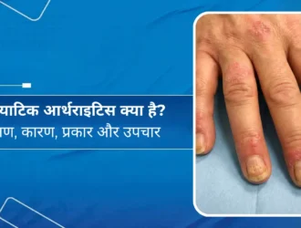 सोरियाटिक आर्थराइटिस क्या है? लक्षण, कारण, प्रकार और उपचार