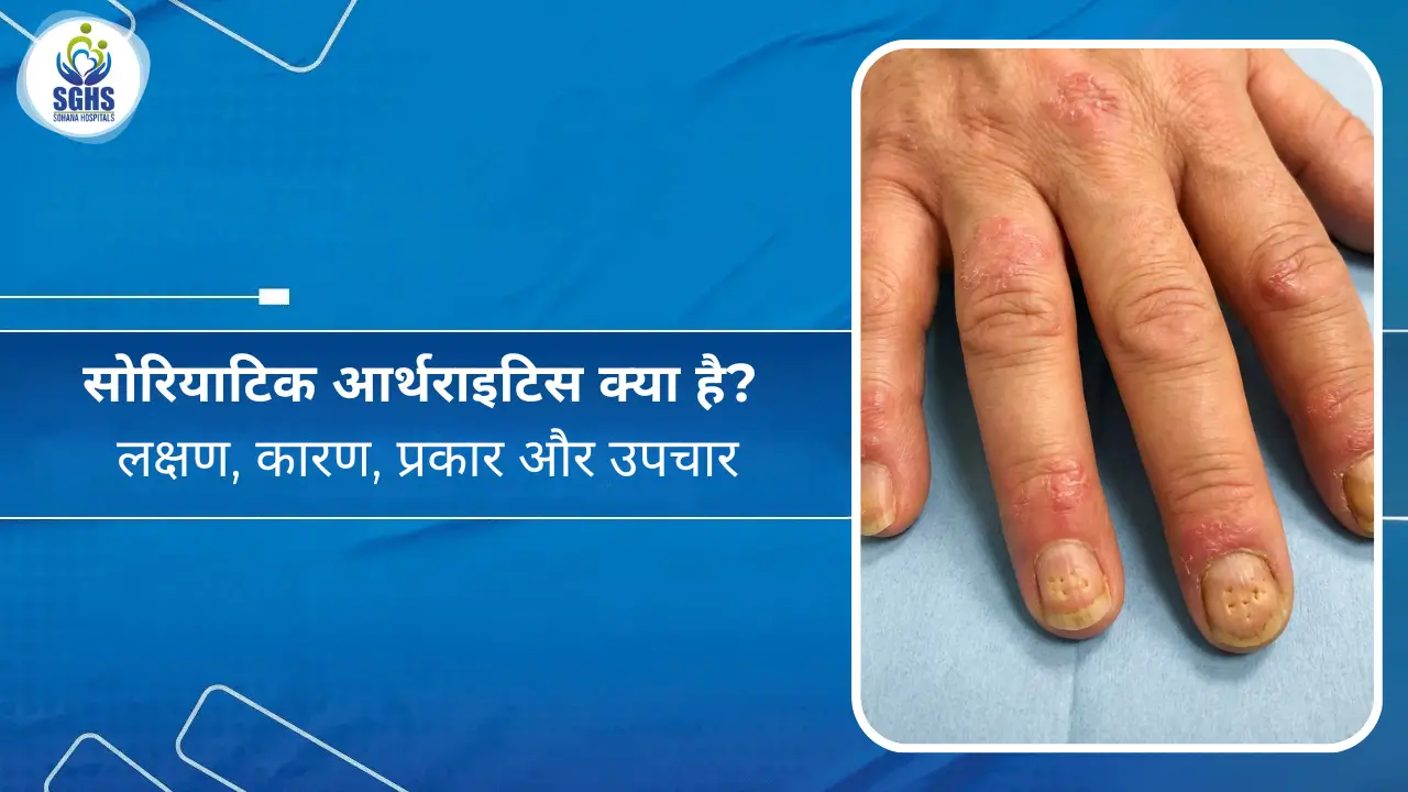 सोरियाटिक आर्थराइटिस क्या है? लक्षण, कारण, प्रकार और उपचार
