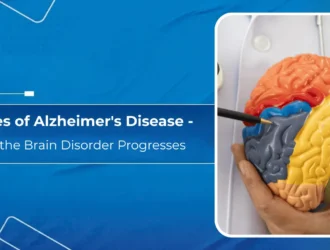 Stages of Alzheimer's Disease - How the Brain Disorder Progresses