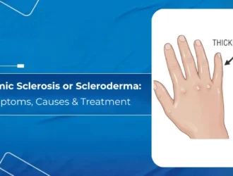 Systemic Sclerosis or Scleroderma - Symptoms, Causes & Treatment