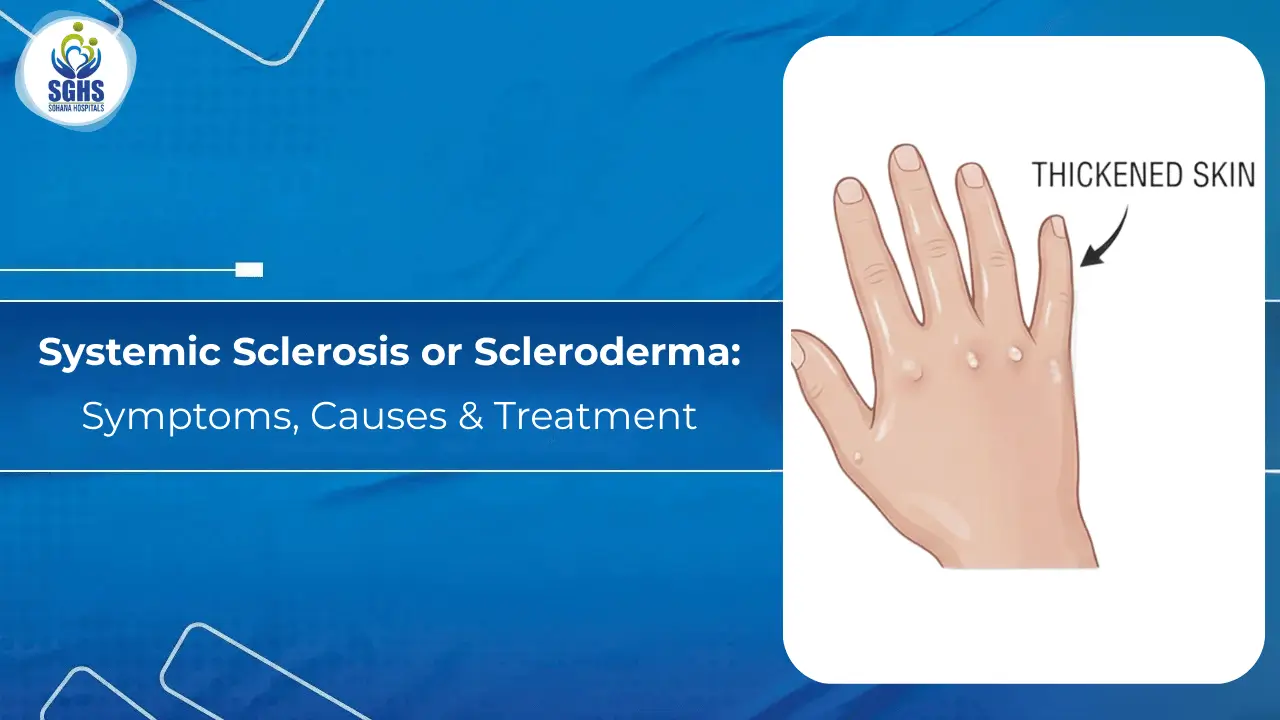 Systemic Sclerosis or Scleroderma - Symptoms, Causes & Treatment