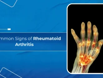 Uncommon Signs of Rheumatoid Arthritis