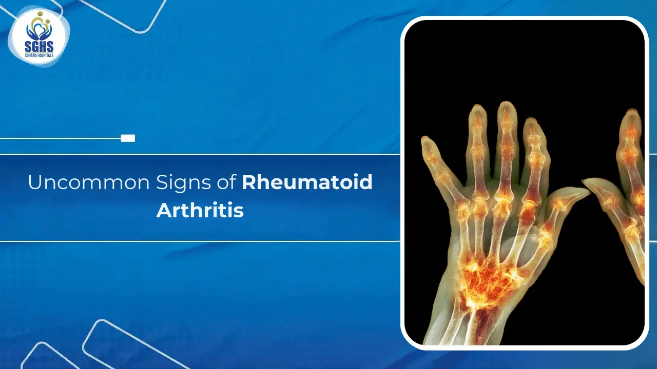 Uncommon Signs of Rheumatoid Arthritis