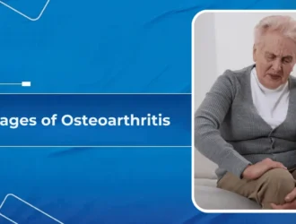 4 Stages of Osteoarthritis