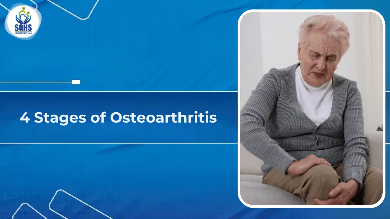4 Stages of Osteoarthritis