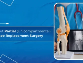 All About Partial (Unicompartmental) Knee Replacement Surgery