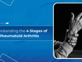 4 Stages of Rheumatoid Arthritis
