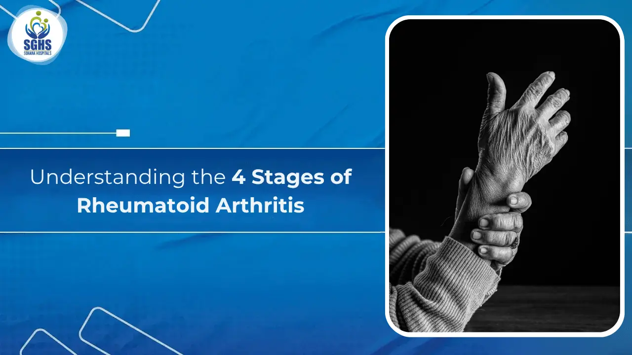 4 Stages of Rheumatoid Arthritis