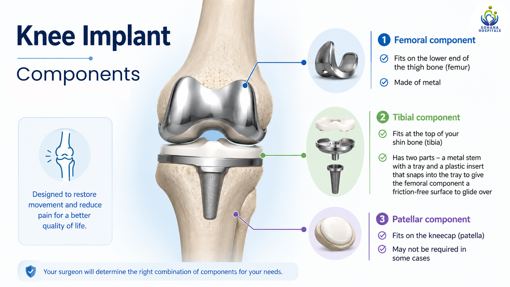 Components in the Knee Implant 
