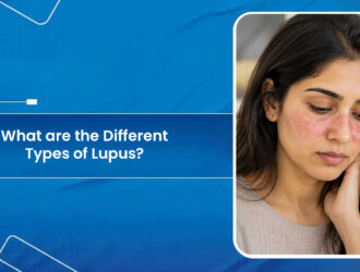 Different Types of Lupus