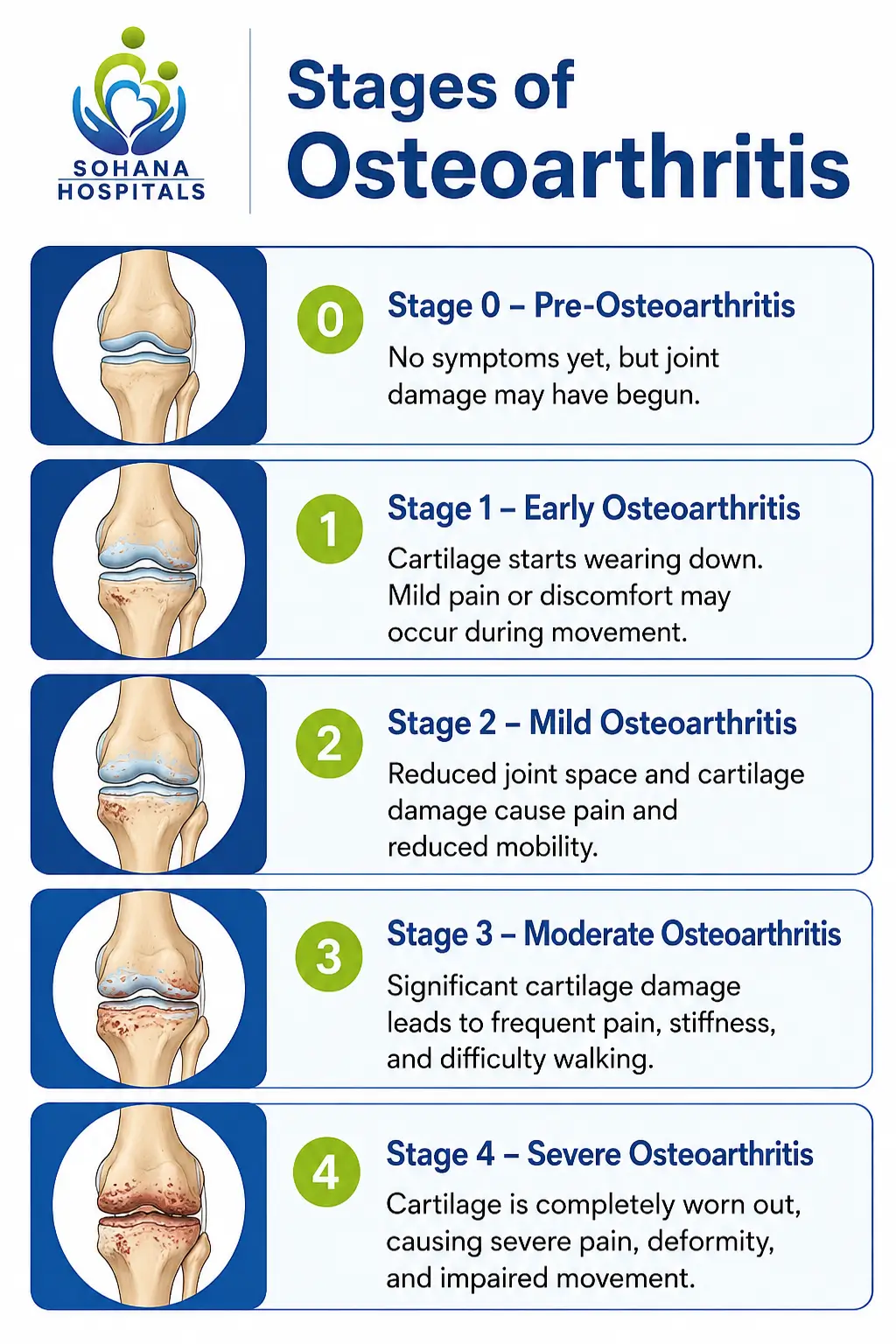 Stages of Osteoarthritis