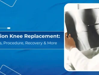 Revision Knee Replacement Types, Procedure, Recovery & More