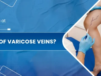 Varicose Veins Treatment