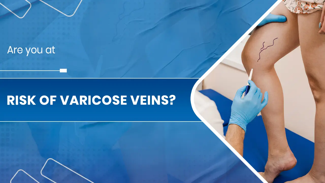 Varicose Veins Treatment