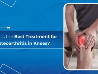What is the Best Treatment for Osteoarthritis in Knees