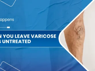 leave Varicose Veins untreated