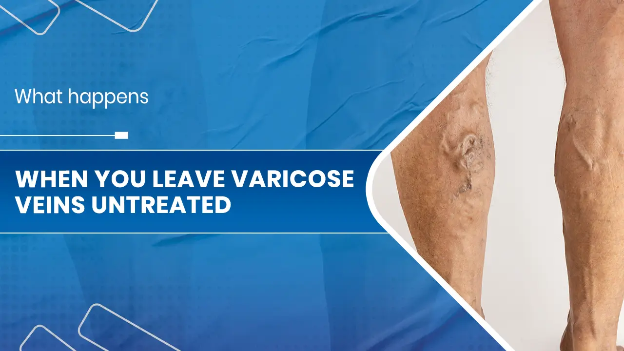 leave Varicose Veins untreated