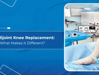 Intellijoint Knee Replacement